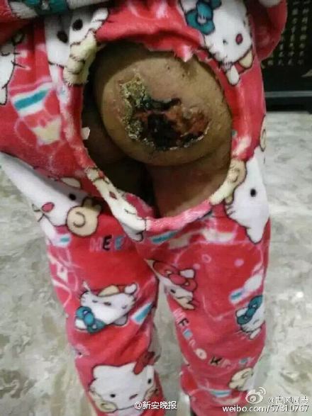 全身遍体鳞伤,伤口被撒盐,双手放在开水泡