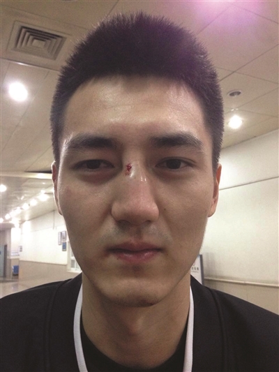 宋建骅鼻梁又被打断