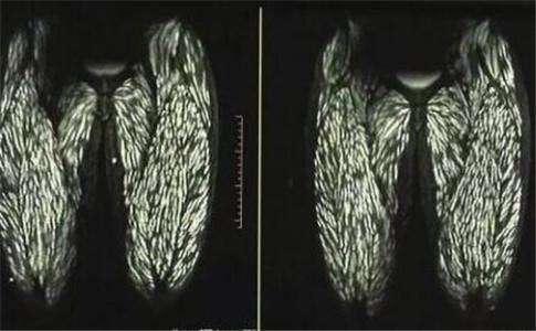 核心提示:最近云南23岁的婷婷全身出现不明原因疼痛,经检查为囊虫