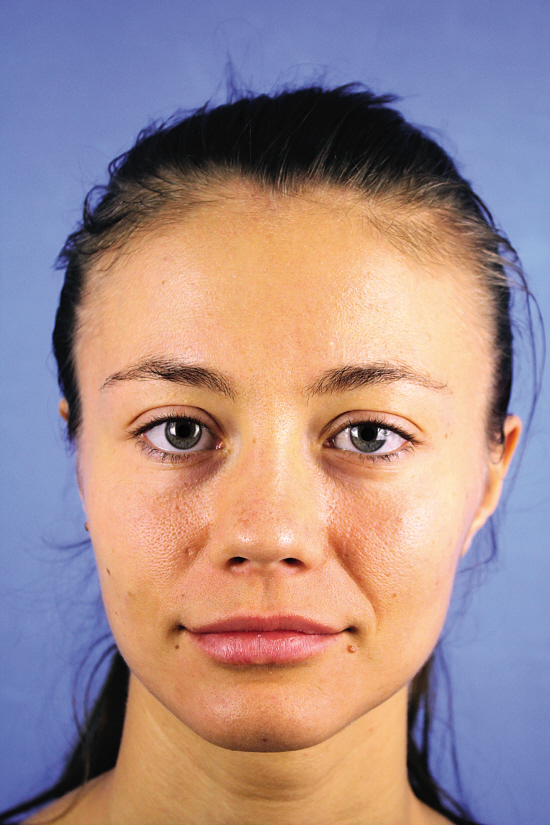 注射隆鼻,丰下巴,丰苹果肌,祛皱纹成最热项目