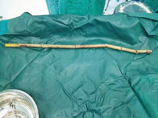 男童竹竿穿体命悬一线