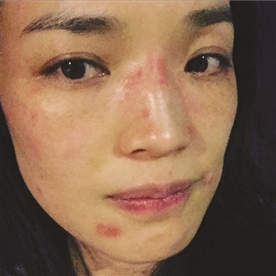 脸上过敏长桃花癣舒淇求分离