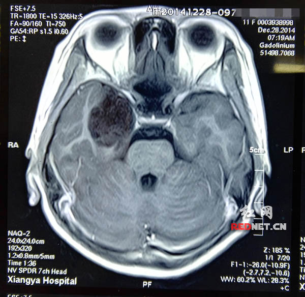 12岁女孩偷窃成瘾 原是颅底肿瘤压迫致人格改变