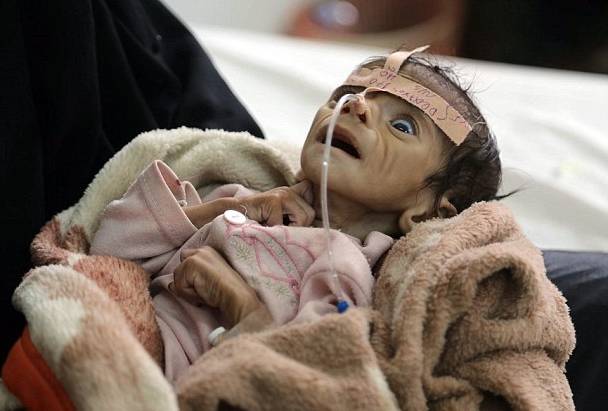 图为也门一个因营养不良而早夭的5个月大的婴儿(图片来源:腾讯新闻)