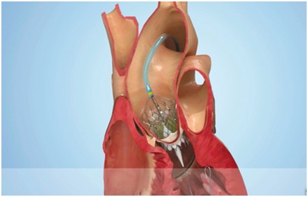 不开刀心脏也能换瓣