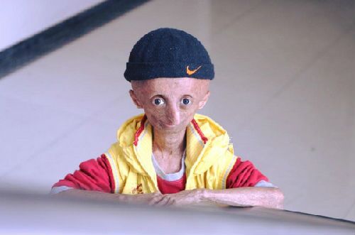 印度一患有罕见早年衰老综合症(progeria,简称早衰症)的少年比特拉