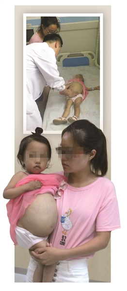 女童肚子鼓如皮球 随时可能胀破