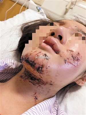 深圳女网红遭车祸毁容