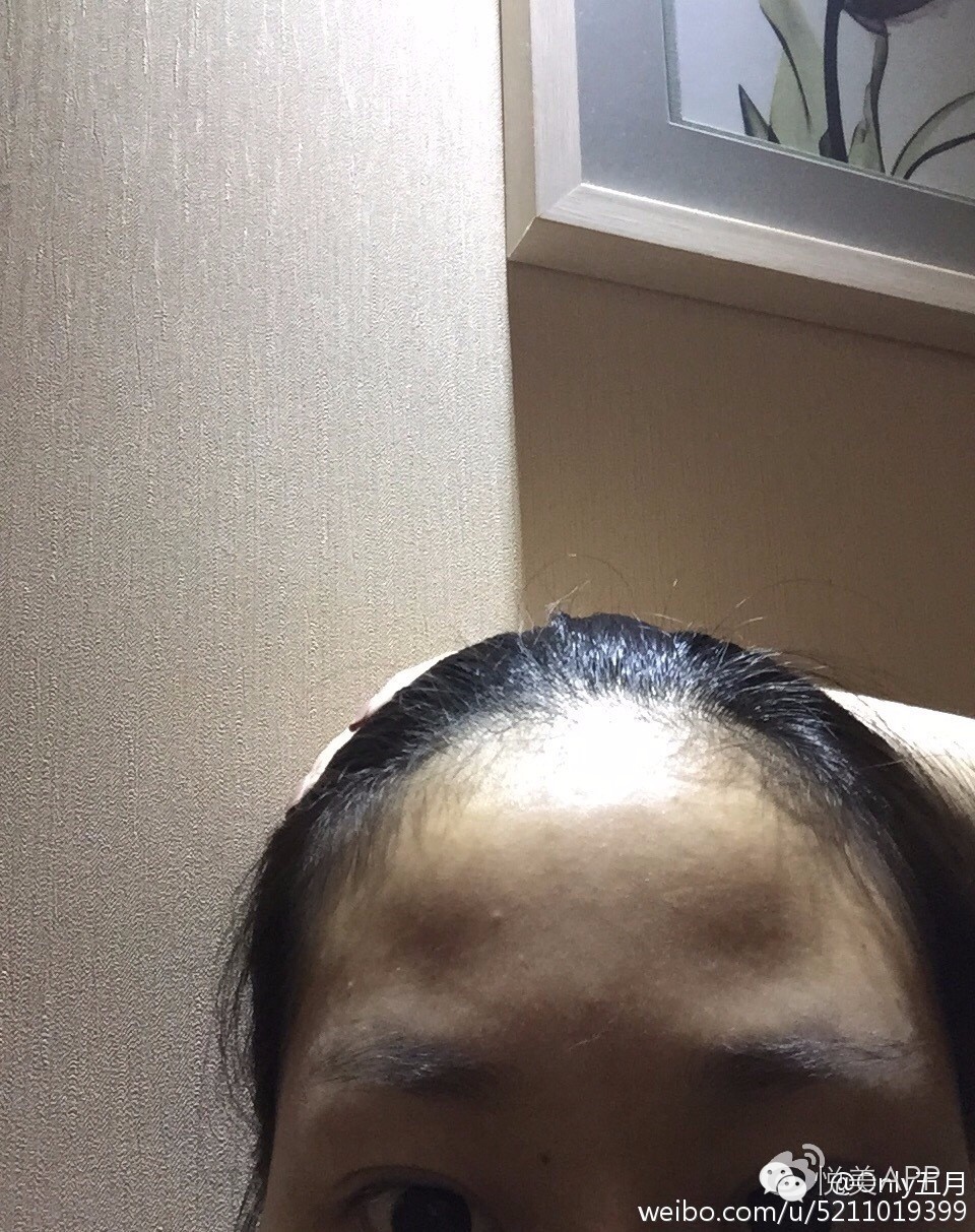 超声刀致网红毁容的背后你还需要知道这些真相