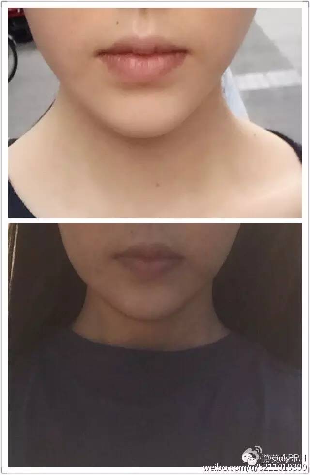 超声刀致网红毁容的背后你还需要知道这些真相