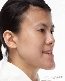 你是地包天都以为明星好当原来偷偷做了截骨术