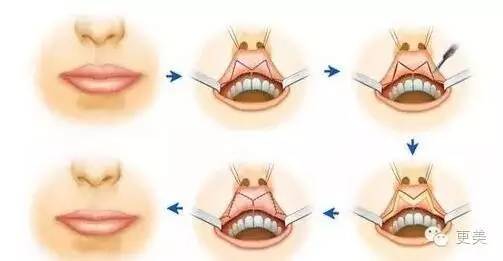 甩掉香肠嘴瞬间让他爱上你的唇