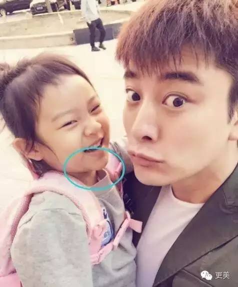 了玻尿酸才有唇窝的,你们考虑过往下巴打了"10斤玻尿酸"的梓晨宝宝吗?