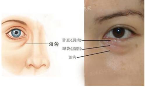 关于眼袋你想知道的都在这篇文章里(二)眶隔释放