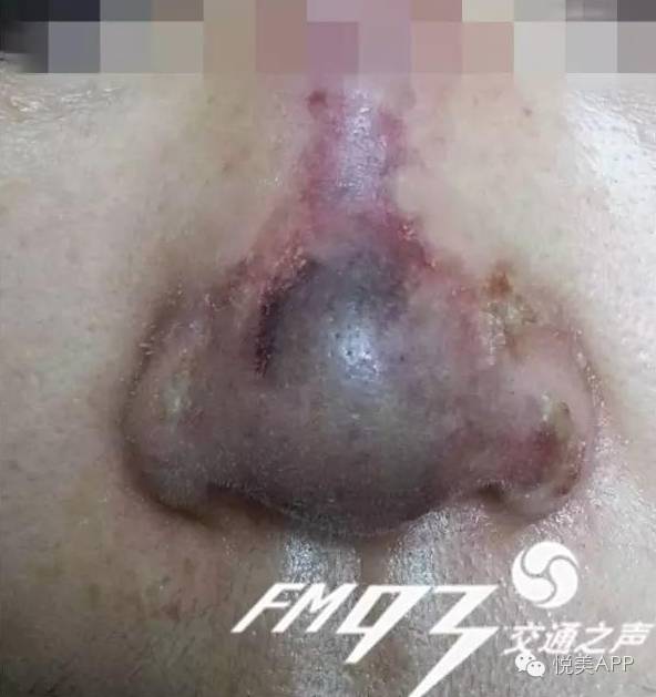 良心说注射填充剂是怎么导致失明的