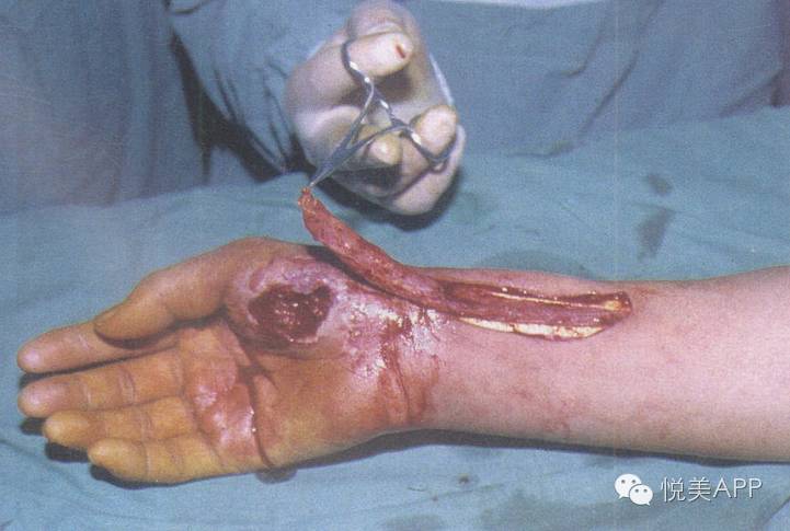 真皮瓣隆鼻隆下巴旧药换新锅小心被忽悠重口