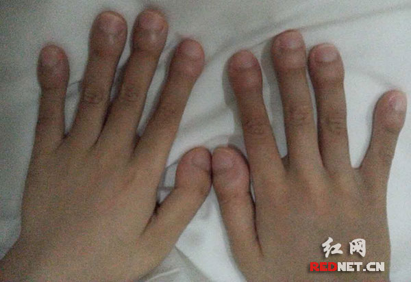女孩手指脚趾变棒槌原是脊柱结核在作怪