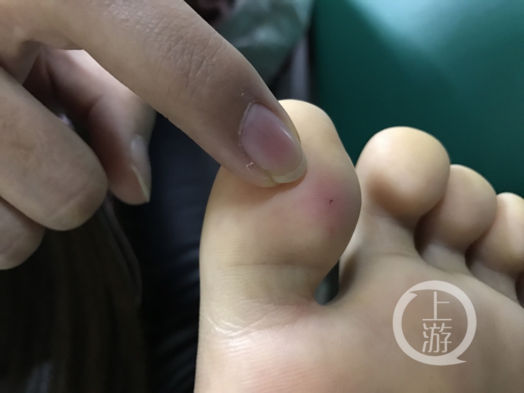 女孩住酒店被针扎伤脚趾缝衣针刺穿拖鞋鞋底
