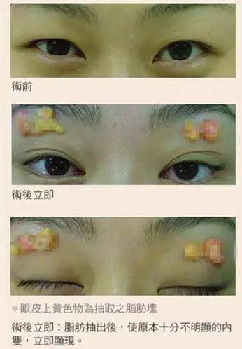 你是肿泡眼吗 如何改变 采美365网