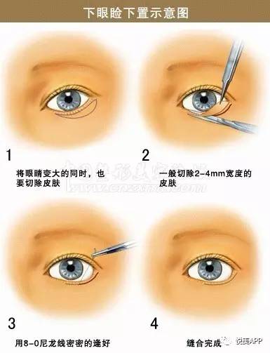 微整形 > 正文  回顾下手术原理:   眼睑下至就是人为造成下睑退缩