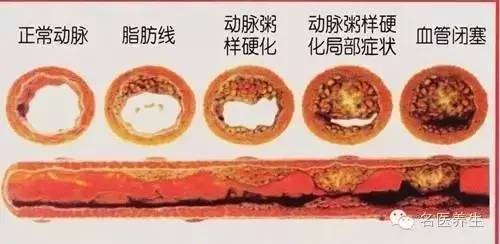 血管外科专家推荐:一个方子将血管壁清理的干干净净!千金难求