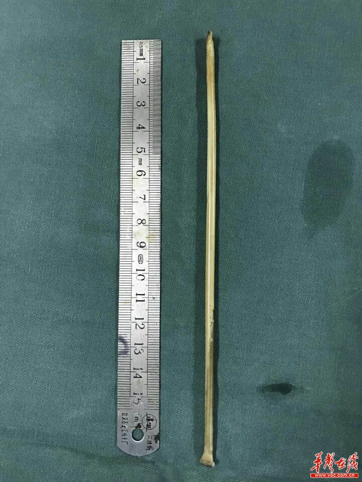 长沙妹子赌气吞下18cm毛衣针滞留腹中八个月