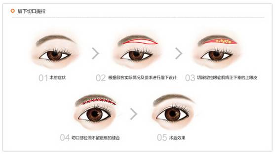 切眉术解决你的三大问题