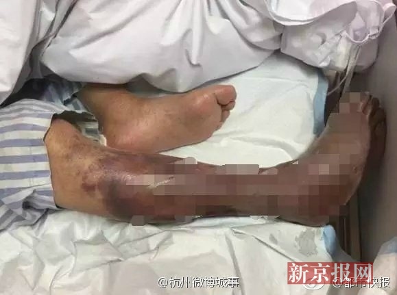 右小腿严重感染,必须截肢才能保命