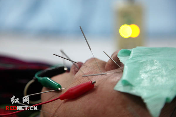 朱女士正在该院综合康复科接受电针治疗红网长沙2月6日讯(时刻新闻
