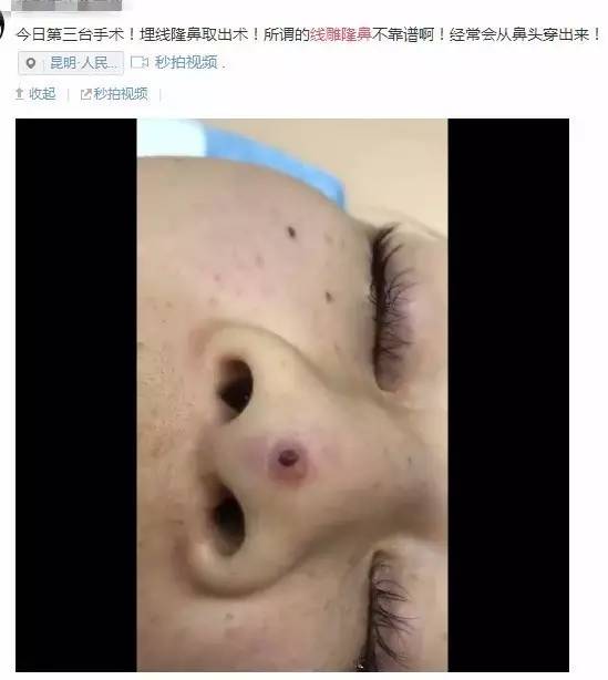 线雕隆鼻要取代假体感觉有点儿扯