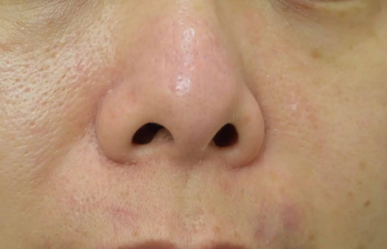 酒渣鼻|鼻头|红斑_新浪女性_新浪网