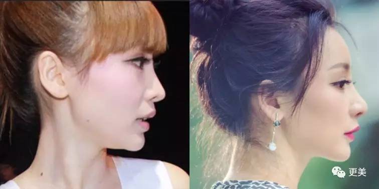 baby当年嘴凸像猩猩真不是牙套能解决的!