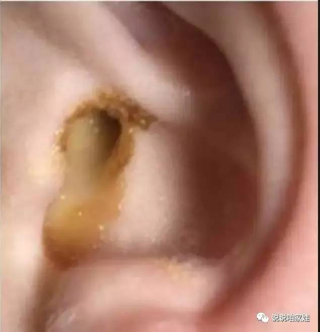 想一想都觉得疼……当脓液造成的压力太大,还会将