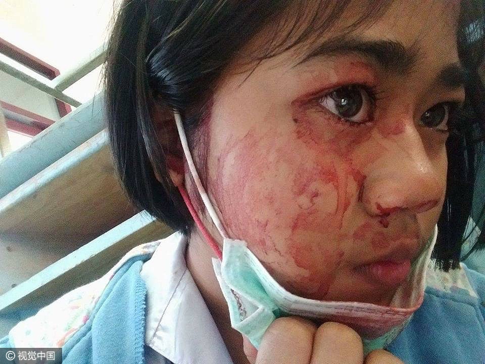 医生诊断称,她可能患有极为罕见的"血汗症".