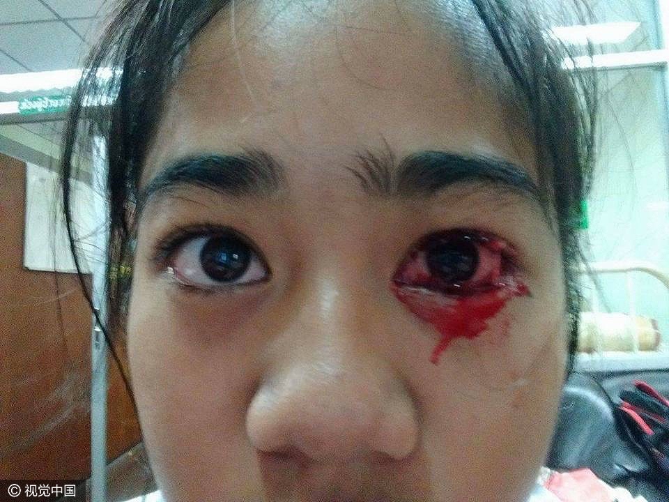 神秘怪病泰国一女孩头痛时眼鼻耳和皮肤就流血