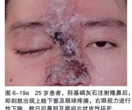 美容院特供永久玻尿酸隆鼻其实是死动物骨粉