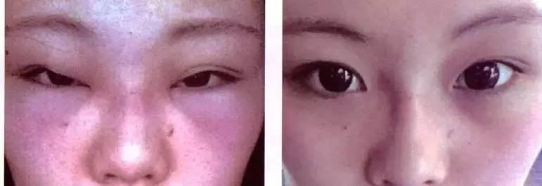个别人注射后多年有鼻部感染,严重的人工骨粉隆鼻后遗症将导致鼻子