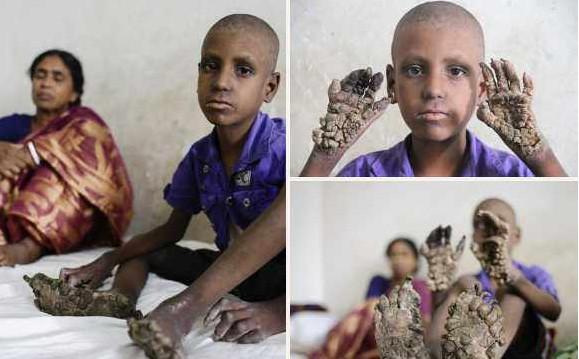 尼泊尔男孩患怪病 皮肤逐渐石化,最终会成石头人不能说话不能动