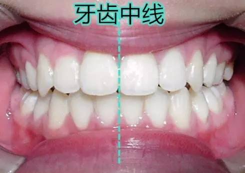 矫正方法视严重程度也有所不同,牙齿中线偏斜在3.