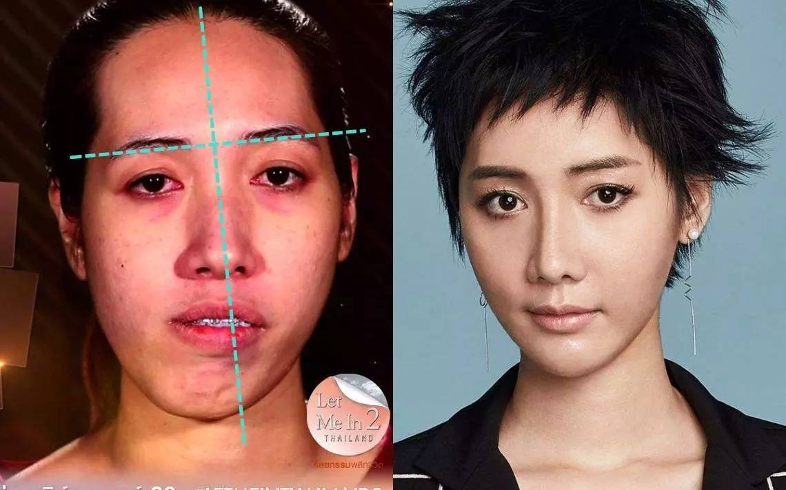 单侧咀嚼,单侧睡觉,跷二郎腿…你的脸正慢慢变不对称|不对称|咬肌