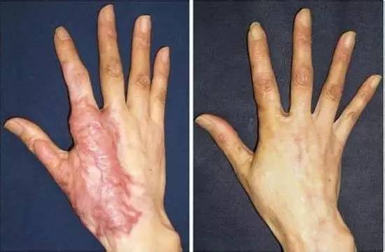 疤痕|皮肤|激光_新浪女性_新浪网