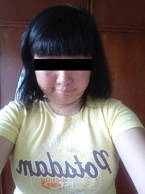 现在的康莫,拍摄于家中康莫因长期服药而肿胀的双脚康莫之后的几次