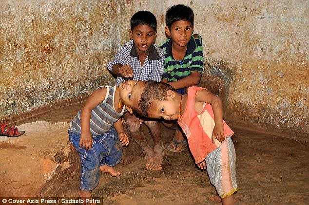 连头双胞胎没钱手术艰难活到两岁政府答应解决医疗费孩子有望看到对方