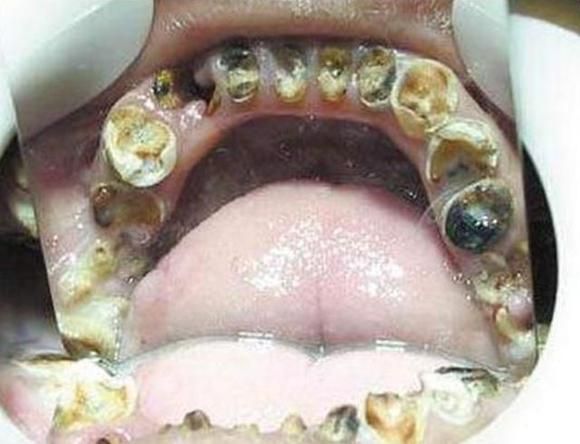 因为妈妈太无知,导致5岁宝宝的牙齿全部烂掉