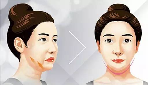 而如果是因为开始下垂造成的下颌线不明显,建议可以尝试埋线提升