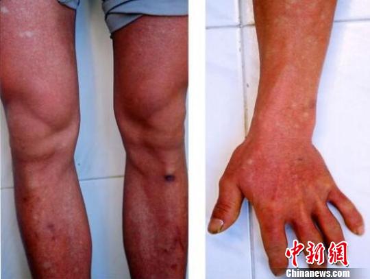 浙江疾控报告上半年登革热病例均为输入型无死亡病例