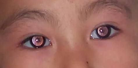 双眼先天性白内障(网络图)