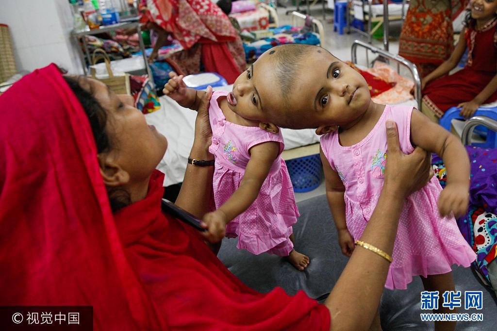 孟加拉国现罕见连体女婴 将接受分离手术父母向政府求资助(组图)