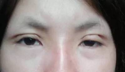 花巨款做的双眼皮埋线崩开开了了