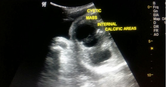 印度惊现胎中胎新生男婴腹中竟怀双胞胎弟弟